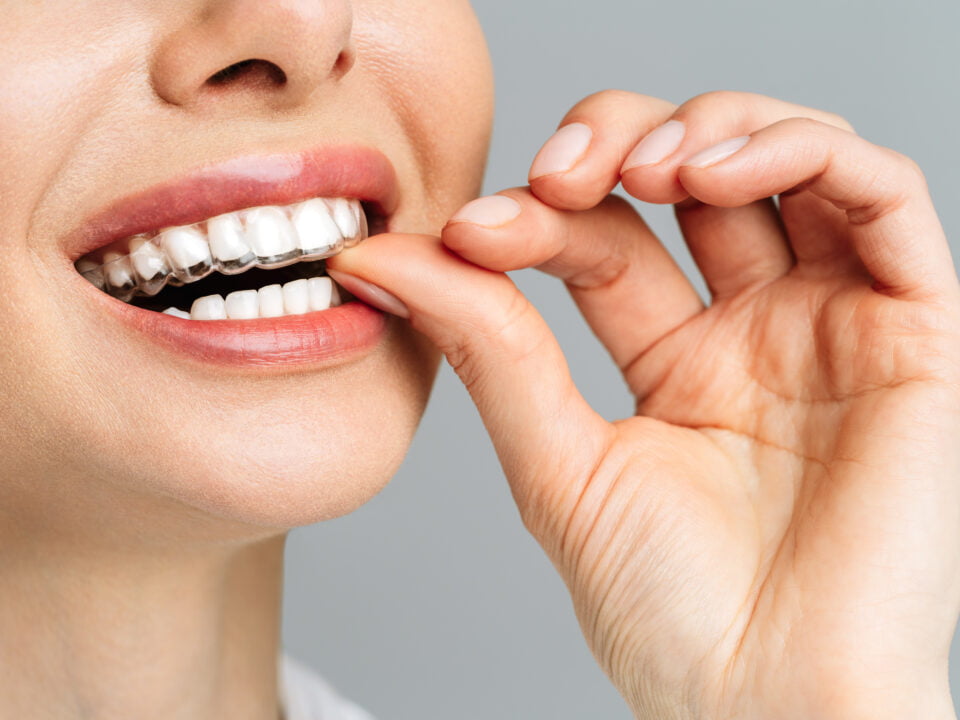 Invisalign é a melhor escolha para o seu sorriso